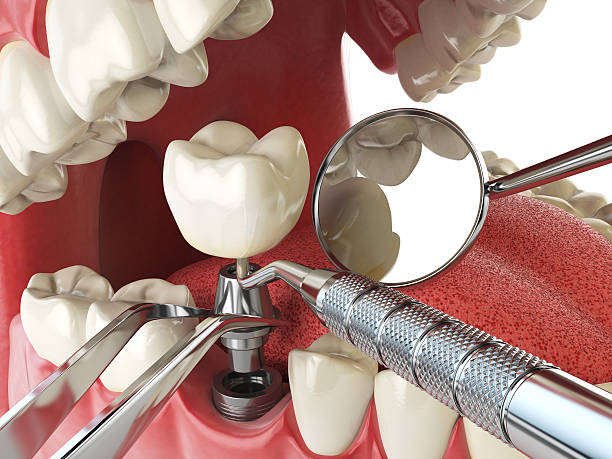 Emergency Dental Filling Replacement in MN